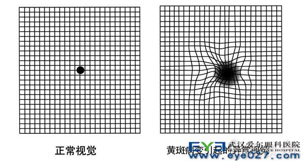 眼底黄斑病变最新最有效的治疗方法探讨